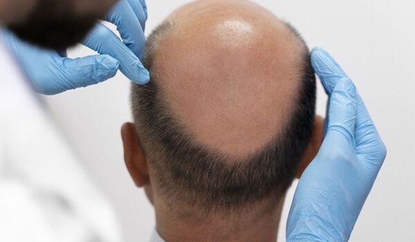 Which is the Best Hair Transplant Clinic in Hyderabad? What You Should Know Before Choosing a Clinic?