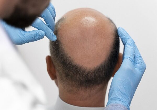 Which is the Best Hair Transplant Clinic in Hyderabad? What You Should Know Before Choosing a Clinic?