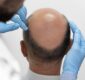 Which is the Best Hair Transplant Clinic in Hyderabad? What You Should Know Before Choosing a Clinic?